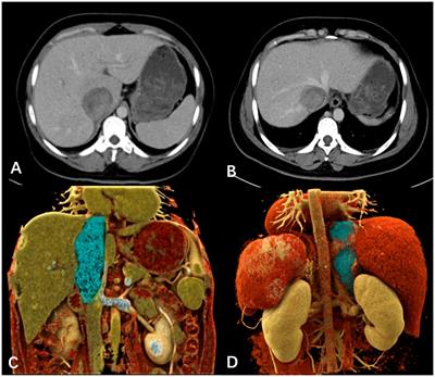 Case Report: Multidisciplinary management of primary inferior vena cava leiomyosarcoma: a comprehensive case study